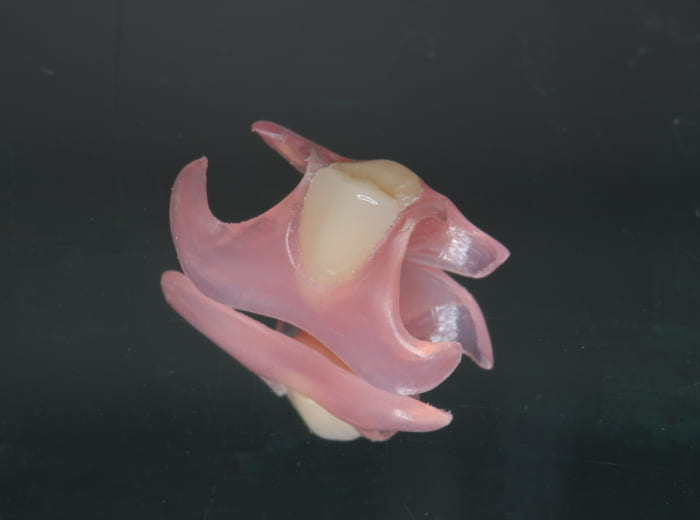 ノンクラスプデンチャー